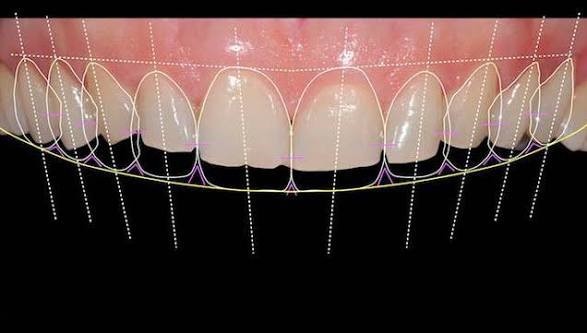 Digital Smile Design graph top