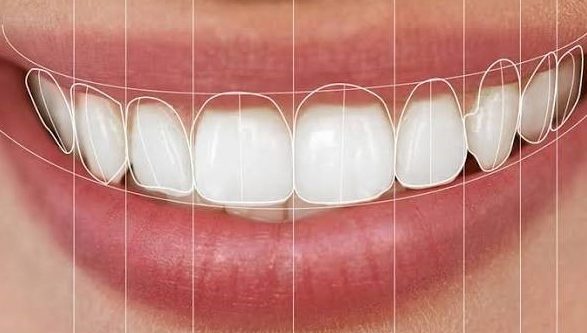 Digital Smile Design smile